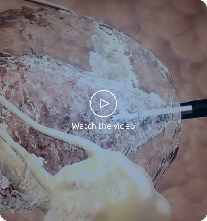 Video cover